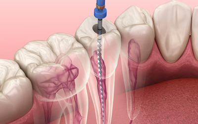 Root Canal vs. Tooth Extraction: What to Expect