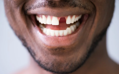 8 Problems caused by missing teeth