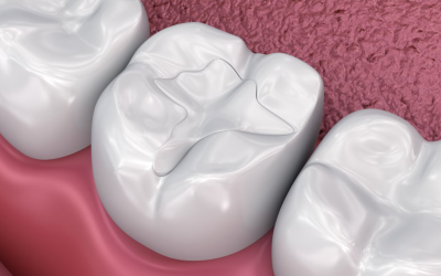 Types of fillings for teeth