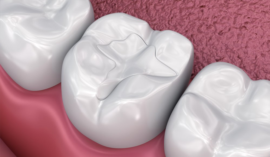 Types of fillings for teeth