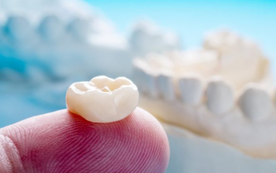 Dental Crowns: Everything You Should Know