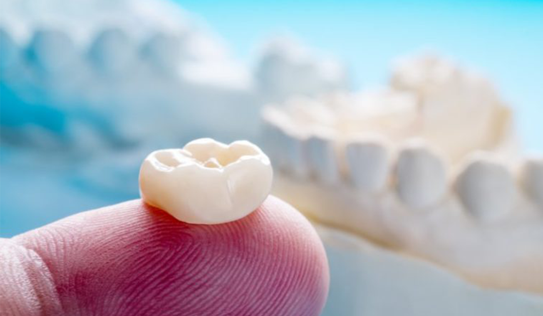 Dental Crowns: Everything You Should Know