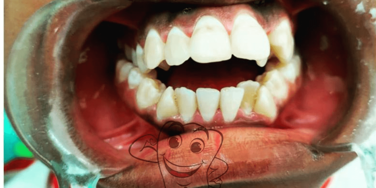 before dental braces 
