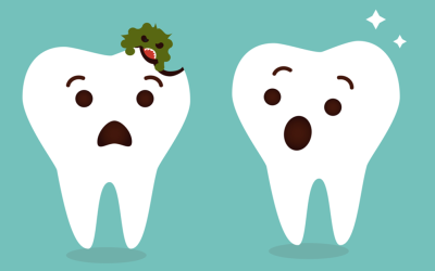 Cavities/Tooth Decay: Causes, Symptoms, Prevention, and Treatment