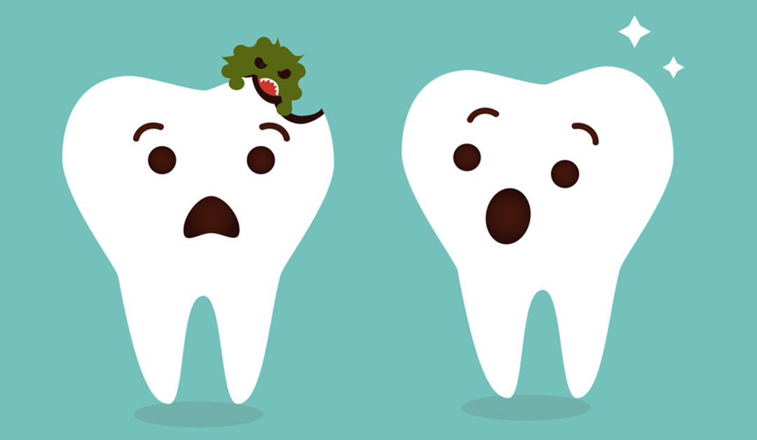 Cavities/Tooth Decay: Causes, Symptoms, Prevention, and Treatment