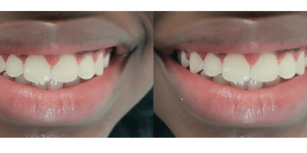 after dental braces 