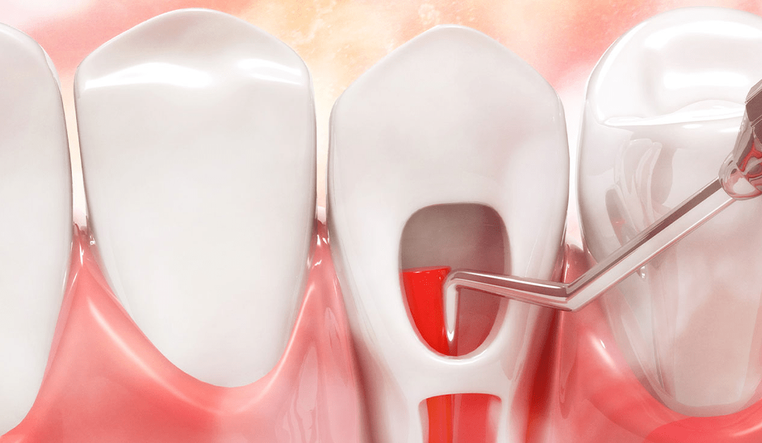 Common Myths About Root Canal