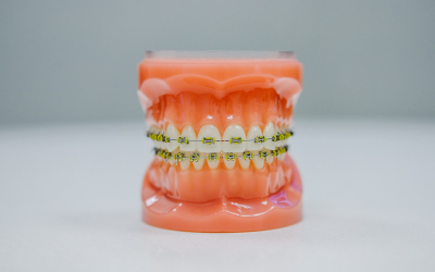 FAQs about Braces Answered