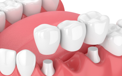 What are Dental Bridges?
