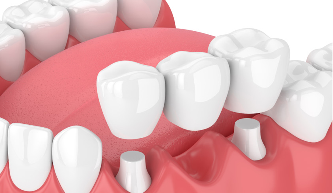 What are Dental Bridges?