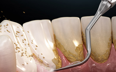 All You Need to Know About Dental Plaque