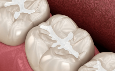 Dental Sealants: What are they?