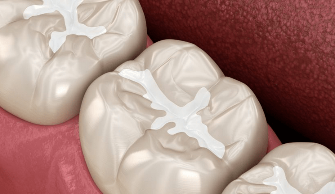 Dental Sealants: What are they?