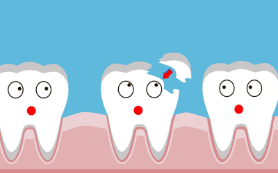 Cracked/Broken Teeth: Causes, Symptoms, Treatment, and Prevention