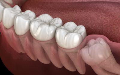 What Does It Mean To Have Impacted Wisdom Teeth?