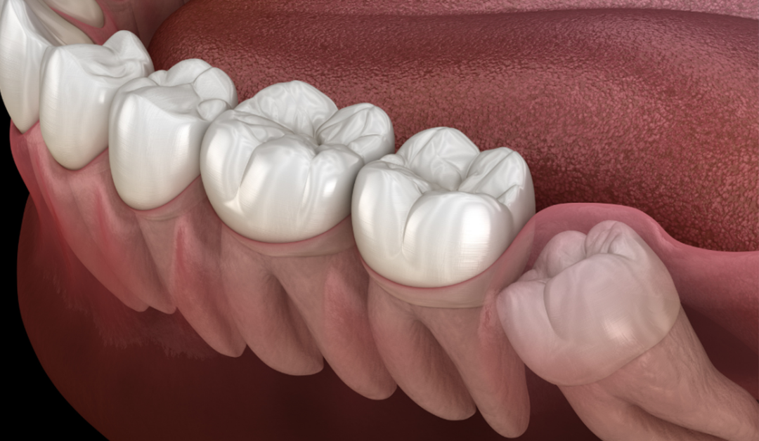 What Does It Mean To Have Impacted Wisdom Teeth?