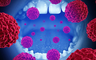 Oral Cancer: Symptoms, Stages, Treatment, and Prevention