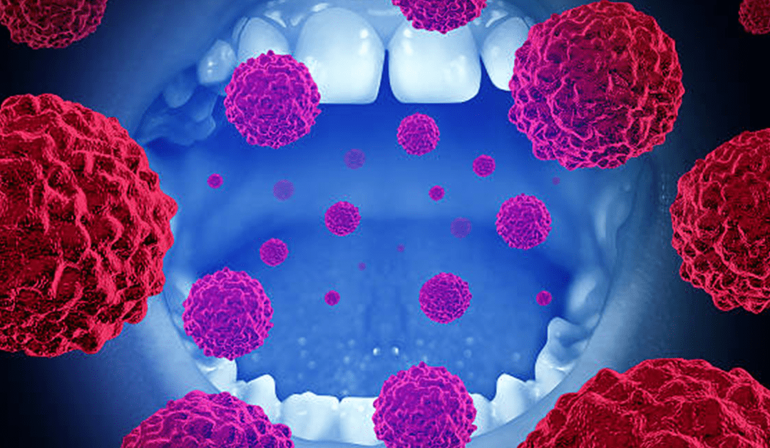 Oral Cancer: Symptoms, Stages, Treatment, and Prevention