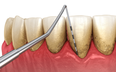 What Is Periodontal Disease?