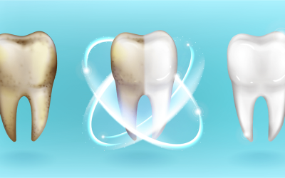 Simple Guide to Teeth Whitening