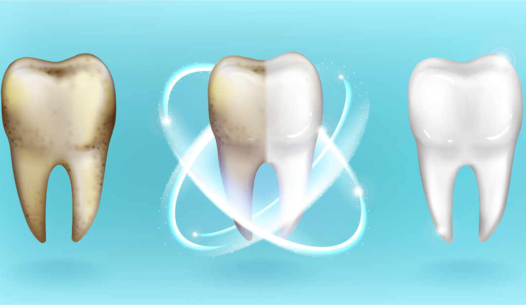 Simple Guide to Teeth Whitening