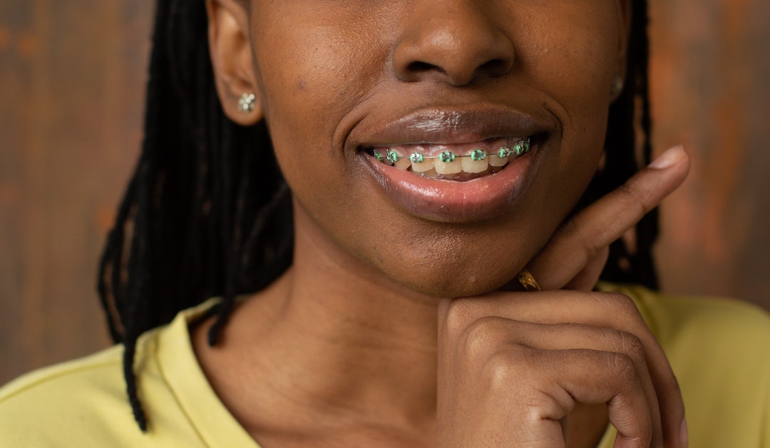 Types Of Dental Braces: Benefits And Advantages