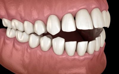 Malocclusion Demystified: Types, Causes, and Effective Treatment Approaches