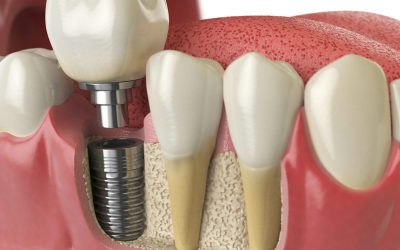 Are Dental Implants Right for You? What to Expect Before, During, and After Treatment