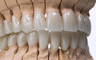Zirconia Full Coverage Veneers: A Durable, Natural Way to Transform Your Smile