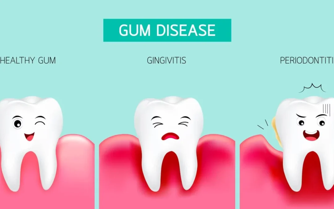 Gum Disease in Kenya: Early Detection and Treatment