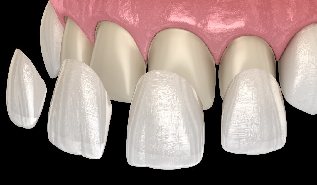 Zirconia Veneers in Kenya: Process, and Longevity